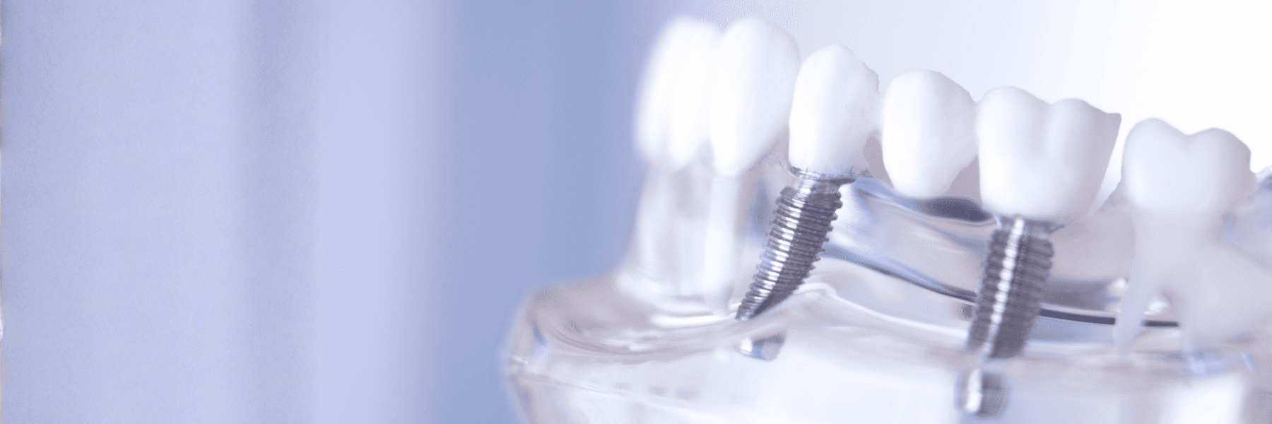 All-on-X Implants | Dentist